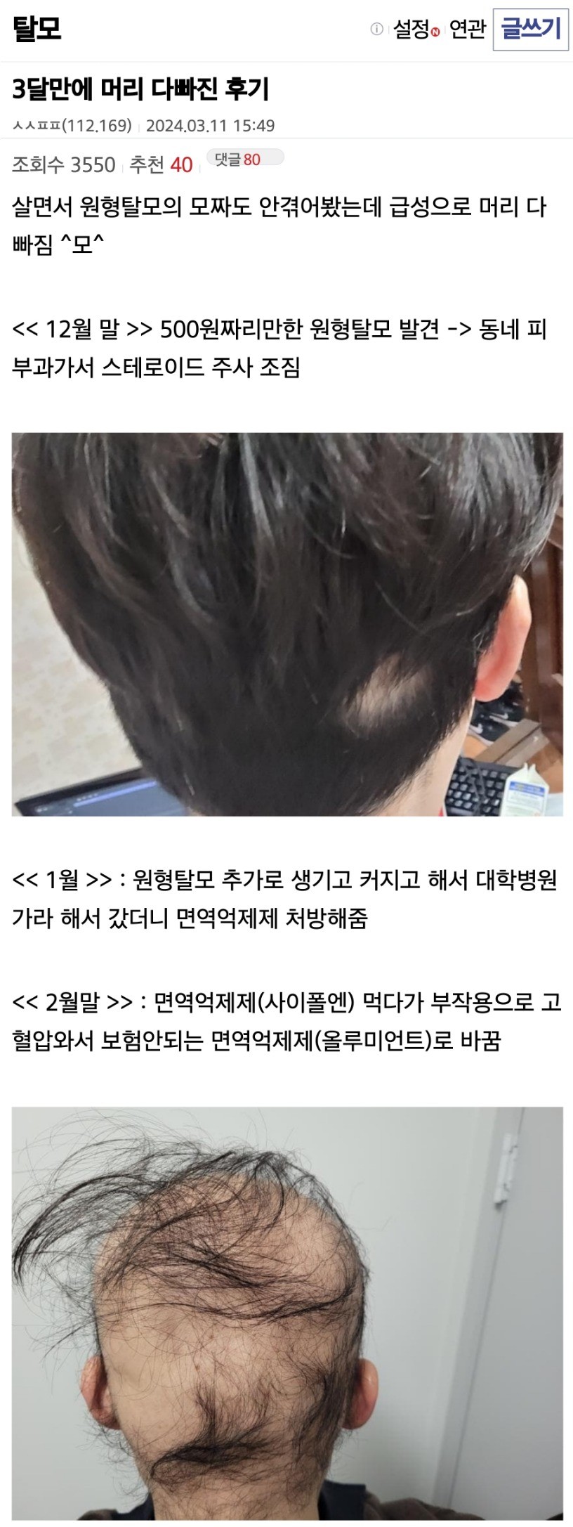3개월 만에 머리 다 빠진 후기 (탈모) | 인스티즈